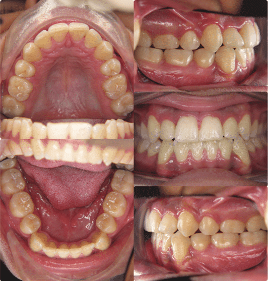 Behandlung mit fester Zahnspange Ergebnis