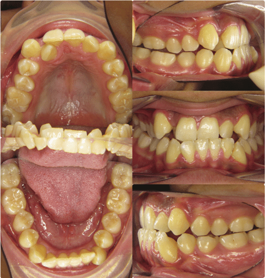 Feste Zahnspange: vor der Behandlung