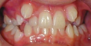 Zahnfehlstellung vor der kieferorthopädischen GNE-Behandlung, Zahnfoto frontal