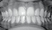 Zähne nach 16 Monaten Behandlungszeit in der Praxis Dr. Madsen