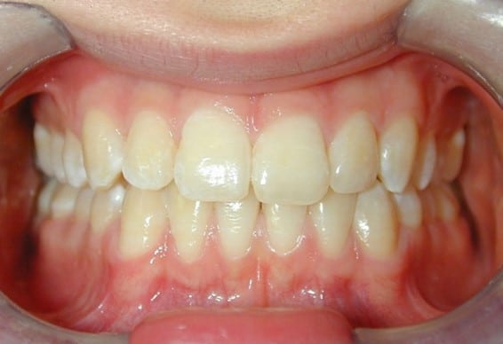 Feste Zahnspange: Behandlungsergebnis
