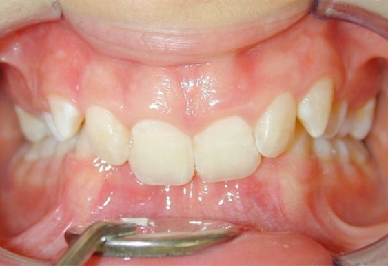 Zähne vor der Behandlung mit fester Zahnspange