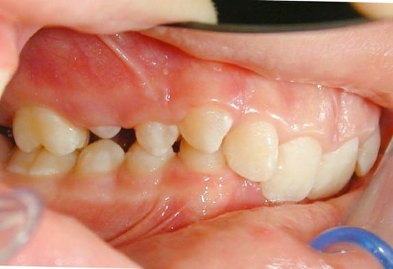 Seitliche Aufnahme der Zähne vor der Behandlung mit fester Zahnspange