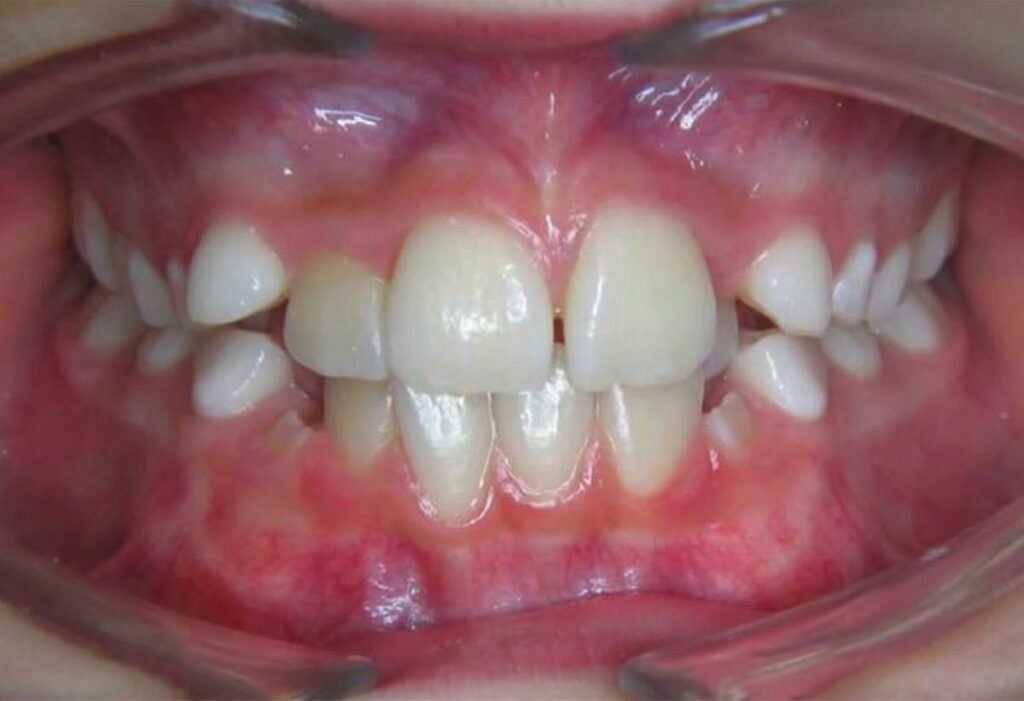 kieferorthopädische Frühbehandlung, vorher, Zahnfehlstellung, frontal