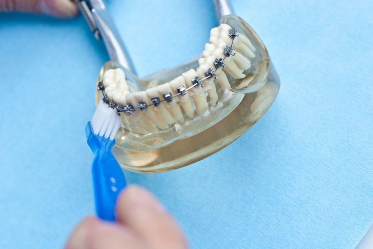 Zahnpflege Mit Fester Zahnspange Dr Madsen