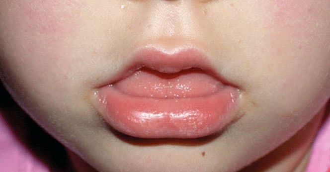 Kind mit offener Mundhaltung und flacher Zungenlage: hier könnte die Myofunktionelle Therapie helfen