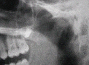 Röntgenbild des Kiefergelenks (Ausschnitt einer Panoramaschichtaufnahme)